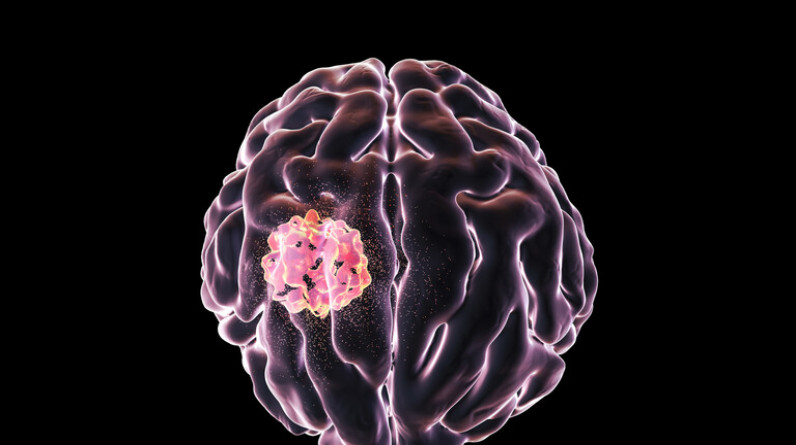 العلماء يكتشفون هدفا علاجيا محتملا لأورام الدماغ العدوانية
